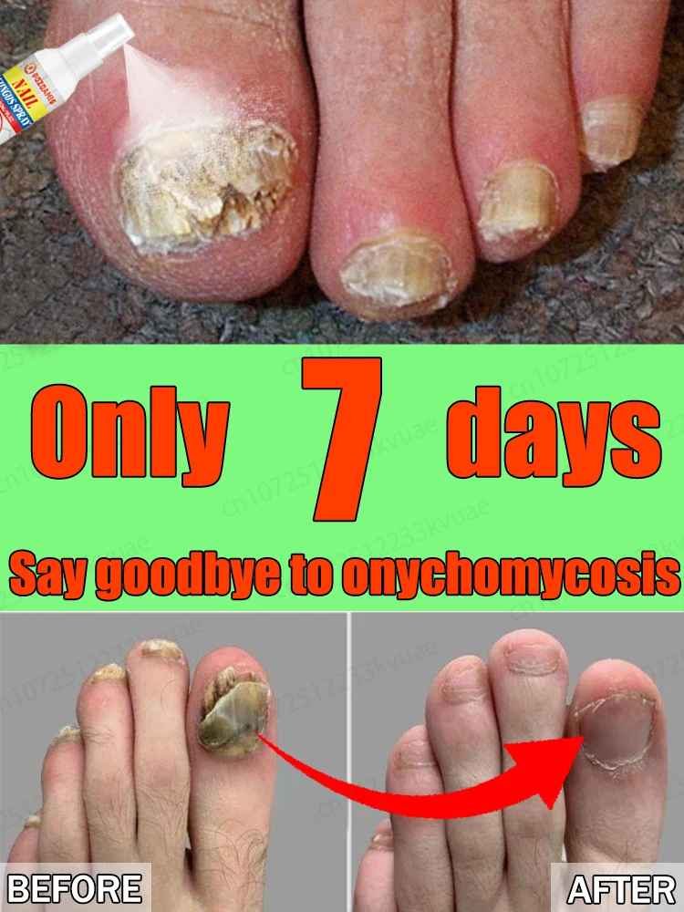 

Say goodbye to onychomycosis. Nail products