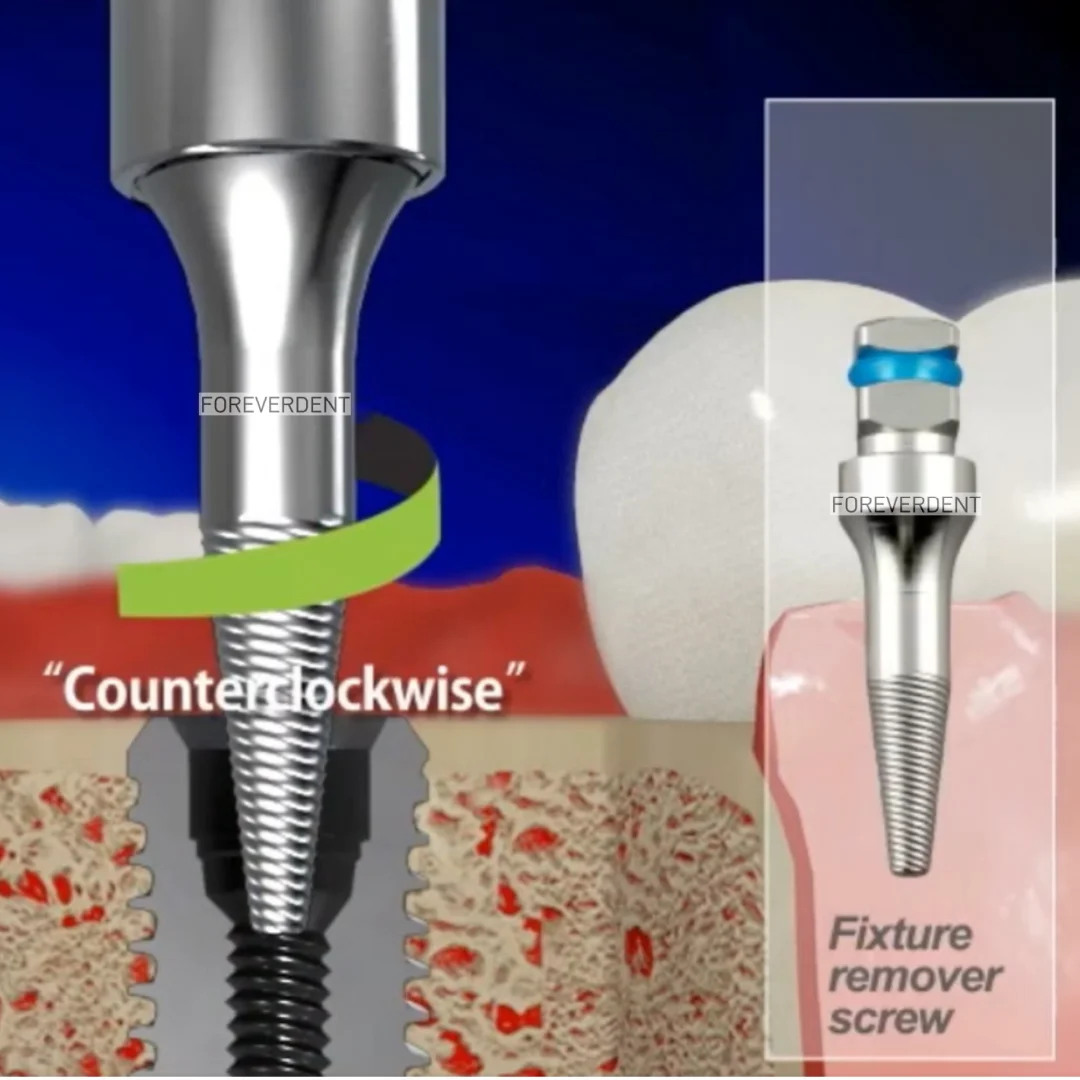 Dental Driver Ratchet Broken Implants Screw Extractor Reverse Drill Pick Up Extractor Failed Fixture Remove SOS Screws