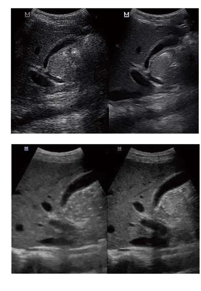 Mindray DP-50 ultrasound machine (with a convex probes)