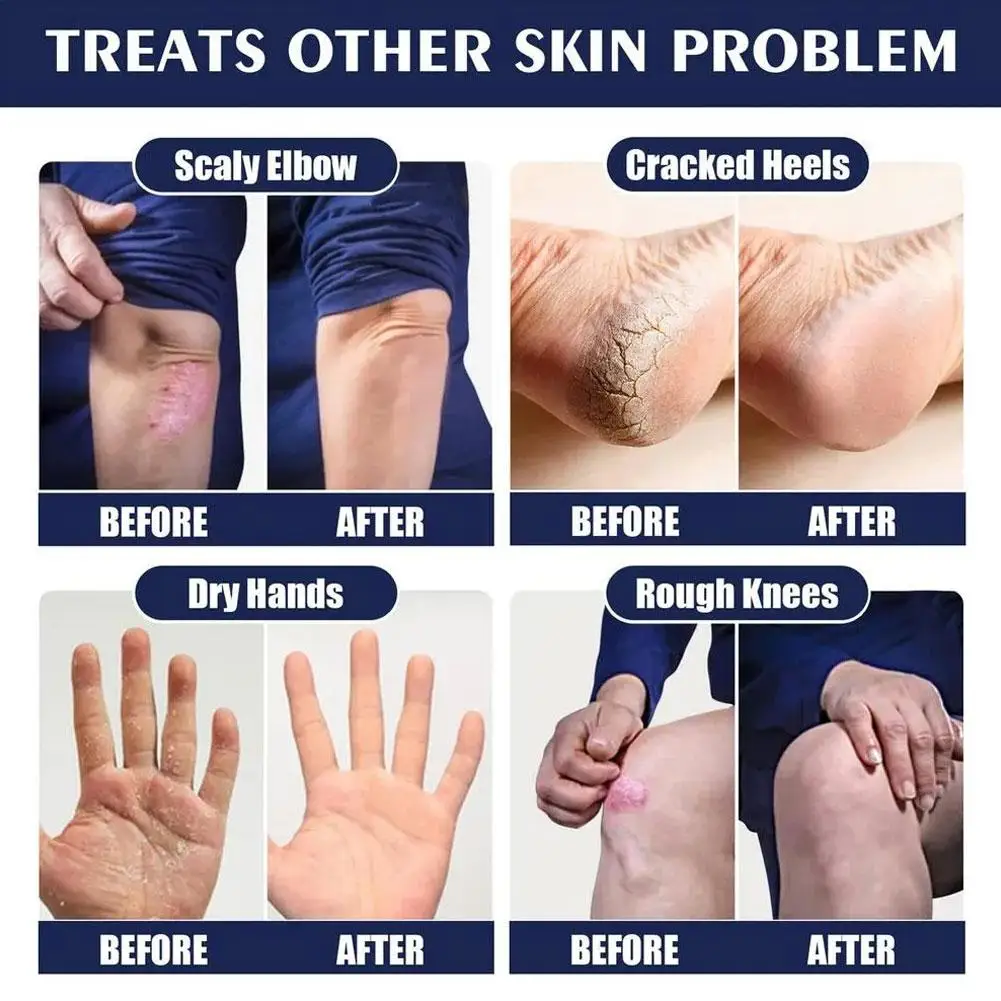 40g Anti Cracking Foot Cream Hand Cracked Repair Cream Hand Removal Anti Dead Cracking Skin Product Care Feet B5P9