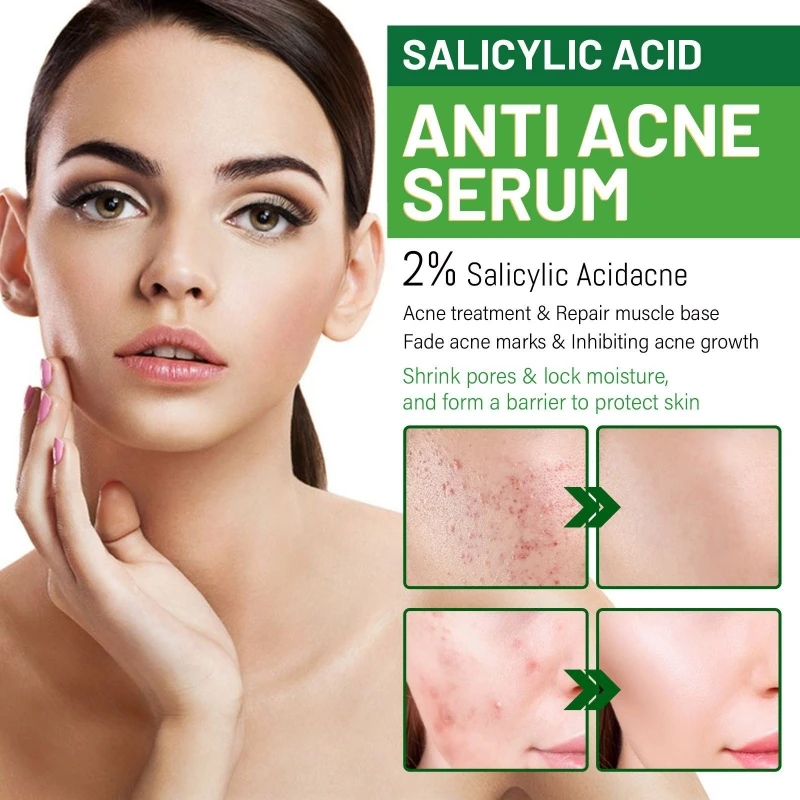 Ácido salicílico Hidratante Soro Rosto, Espinha, Cicatriz, Remoção Cravo, Encolher Poros, Controle De Óleo, Tratamento De Acne, Cuidados Com A Pele