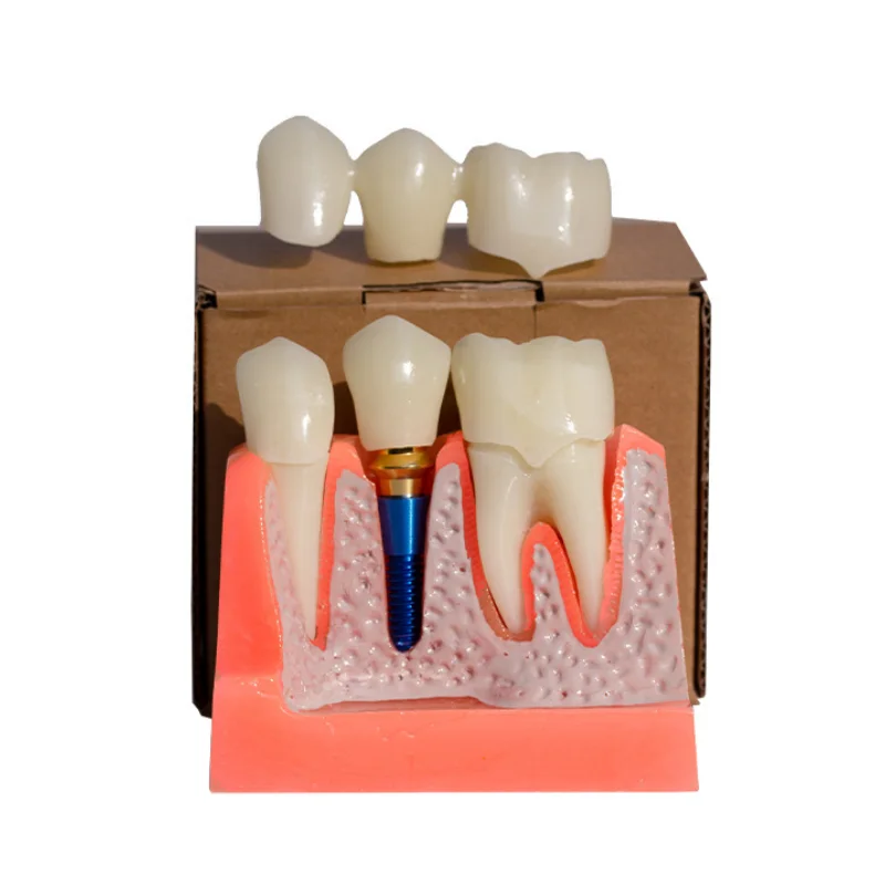 Dental Teeth Implant Model 4 Times Caries Comparsion Study Denture Models Analysis Crown Bridge Porcelain Restoration Study