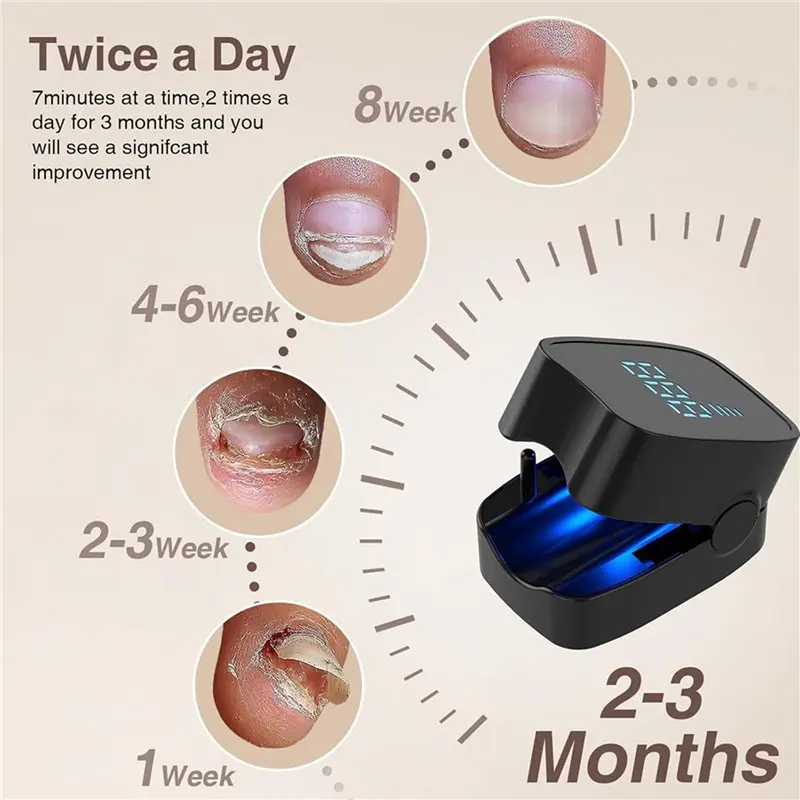 【POPULAR】2 dispositivos de tratamento de fungos nas unhas 905Nm infravermelho e laser LED azul de 470Nm, terapia eficaz de onicomicose preta