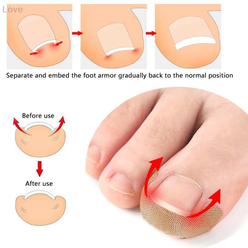 5 hojas de parche para tratamiento de uñas, antiinfección, paroniquia, onicomicosis, uñas encarnadas, ranura, corrección de hongos, pegatina de reparación