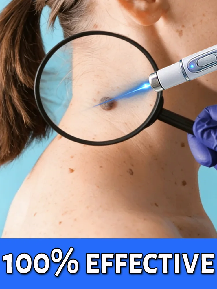 

1st Nanometer-level laser effectively removes stubborn warts