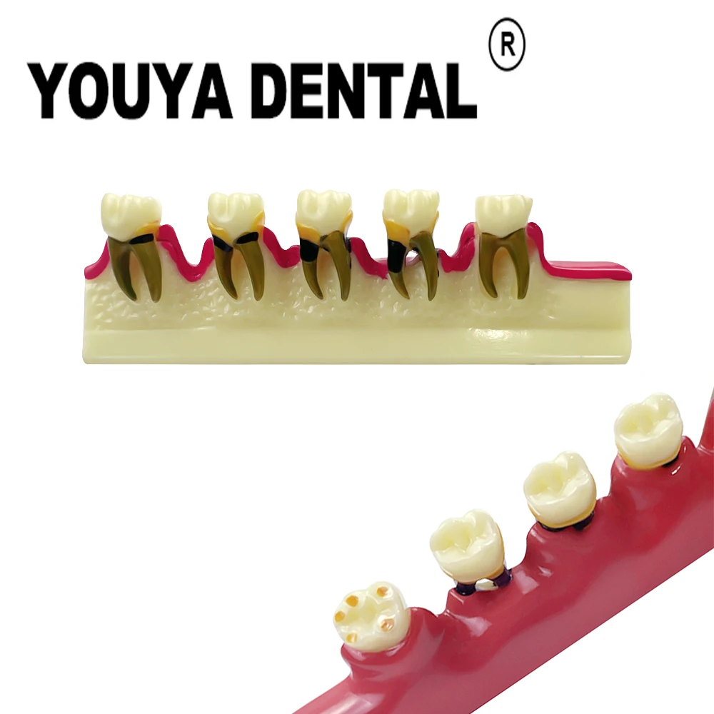 Tooth Model Periodontal Disease Progression Model For Dentist Technician Teaching Studying Doctor-patient Communication Tools