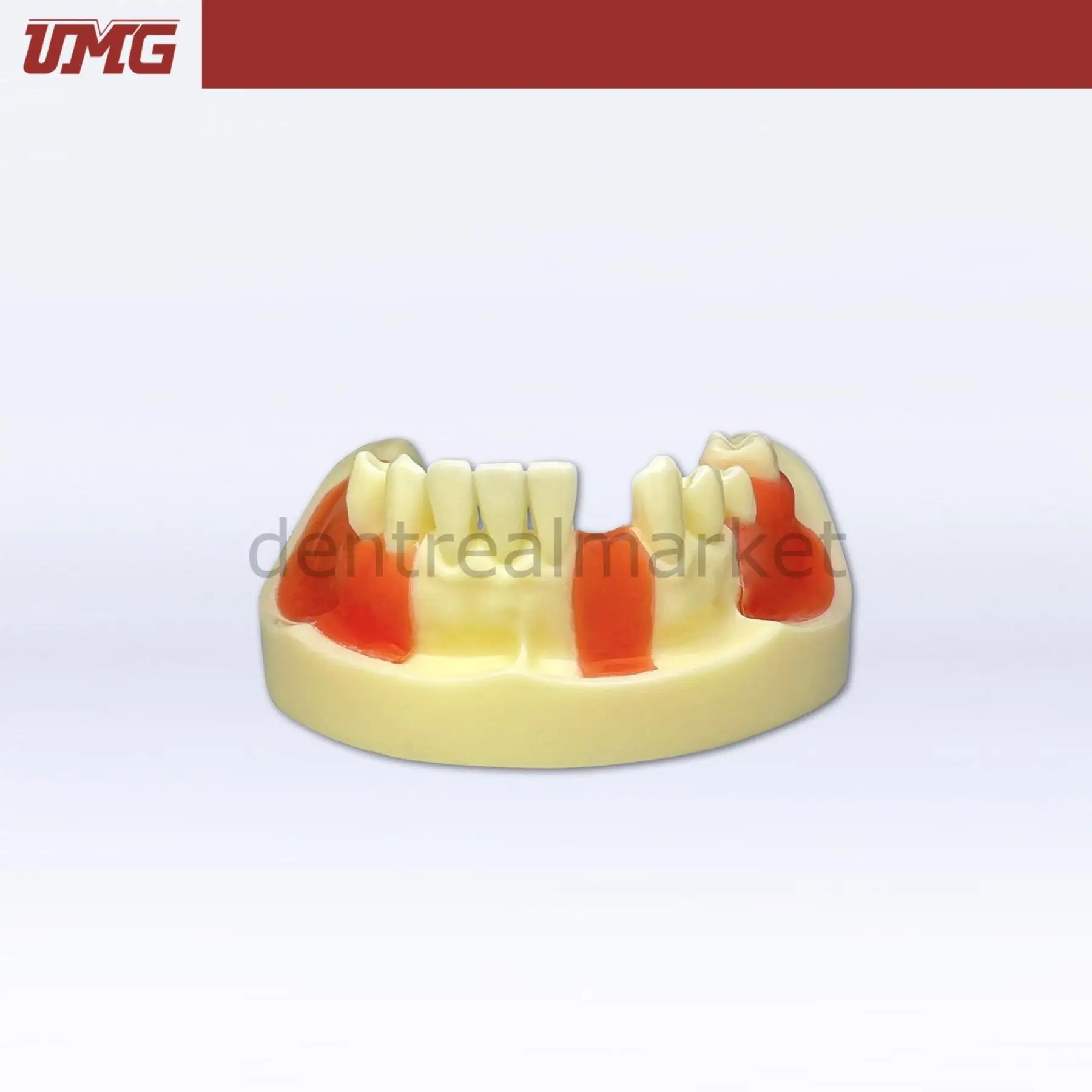 Umg Dental - Umg Model Implant Training Model With Gingiva - UM-Z2-01