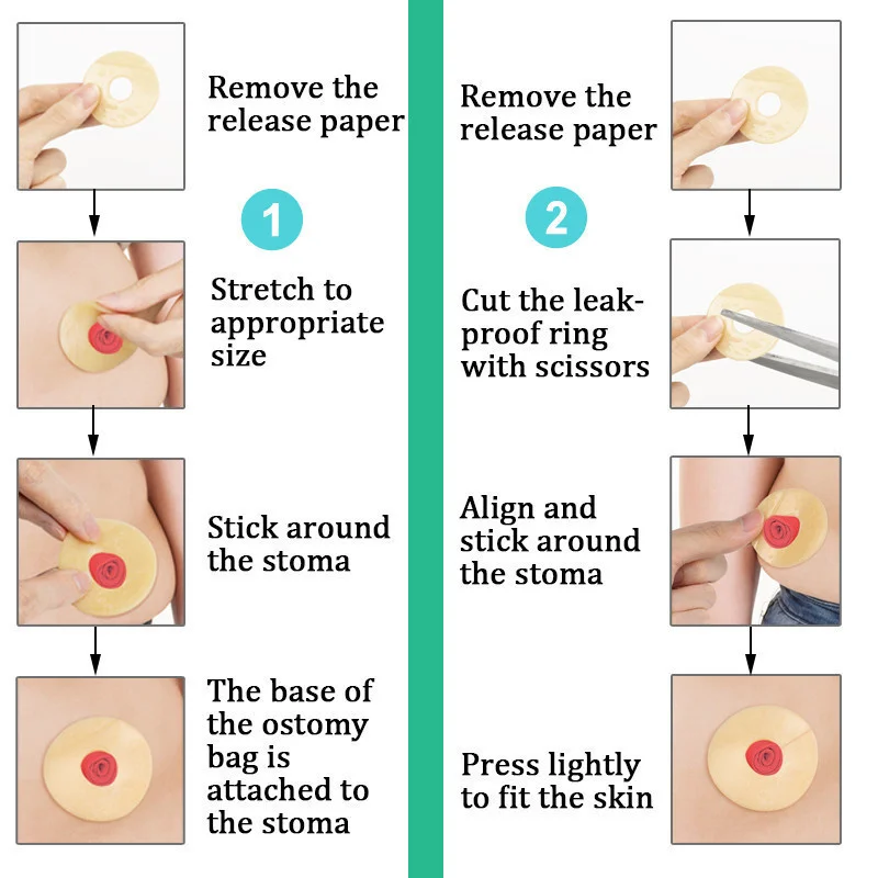 10 Pcs/box Colostomy Bag/urostomy Bag Leak-Proof Ring Leak-Proof Patch Ring Attachment Glue for Fistula Opening Chassis