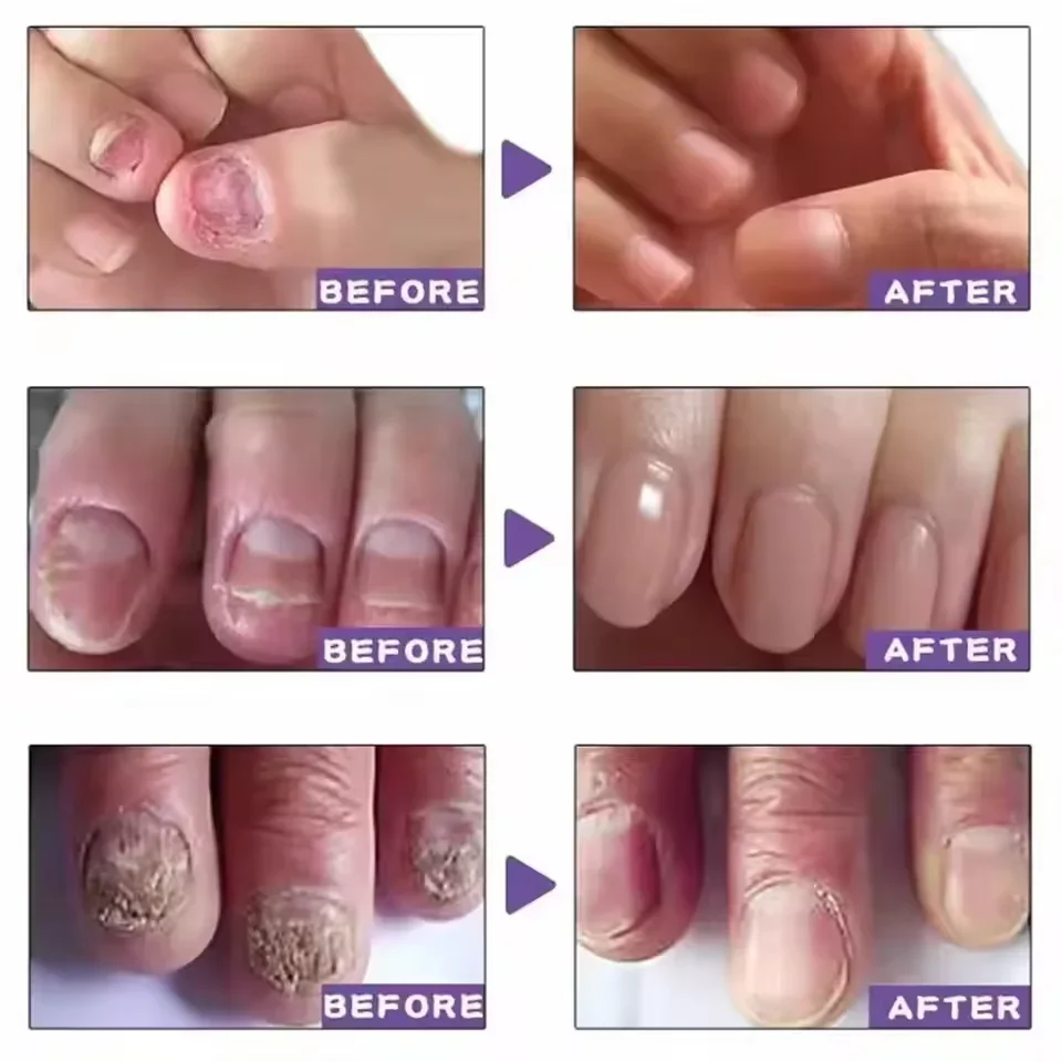 7 DAYS Nail Fungus Treatments Liquid Serum Anti-Infection Onychomycosis Paronychia Hand Care Nails Foot Fungal Removal Gel 10ml