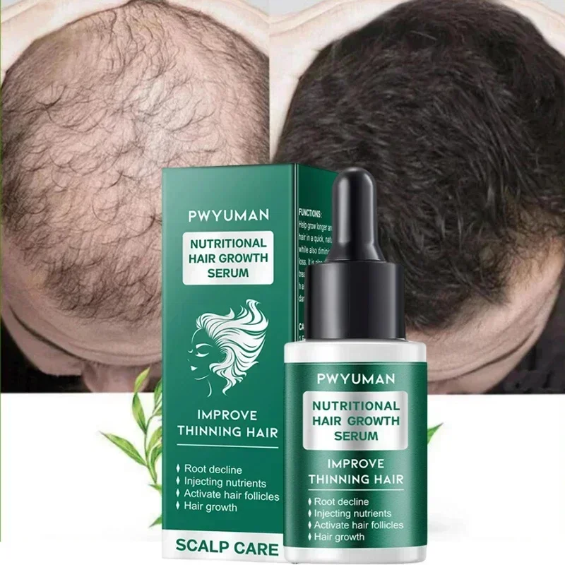 Suero de crecimiento rápido del cabello, aceite esencial antipérdida de cabello, previene la calvicie, nutre el tratamiento del cuero cabelludo, productos para reparar el crecimiento del cabello