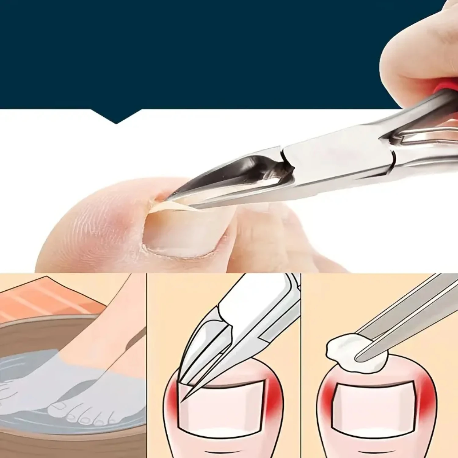 Professional Stainless Steel Nail Clippers for Improved Paronychia Care