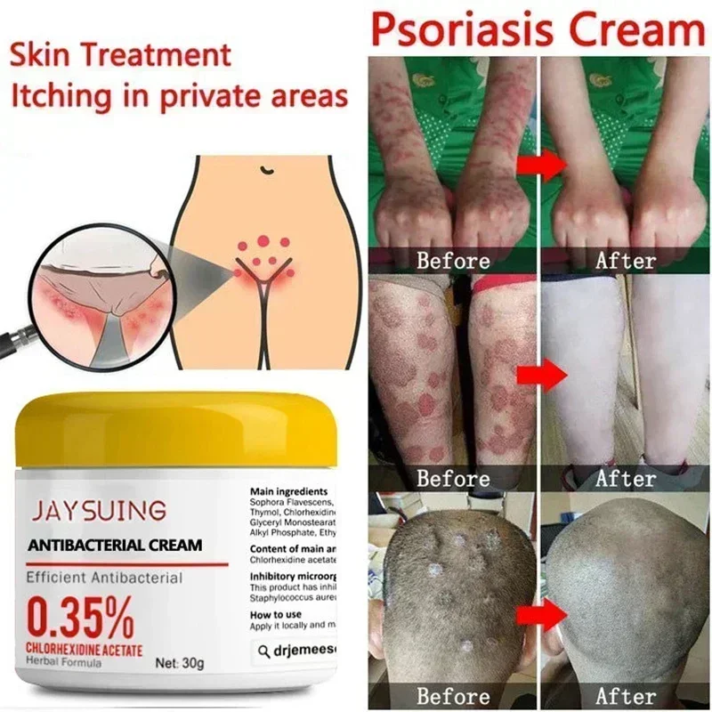 

HOT SALEPsoriasis Moisturizing Cream Natural Repair Antibacterial Relieve Exfoliate Dry Skin Itchy Rough Skin Care Moss Removal