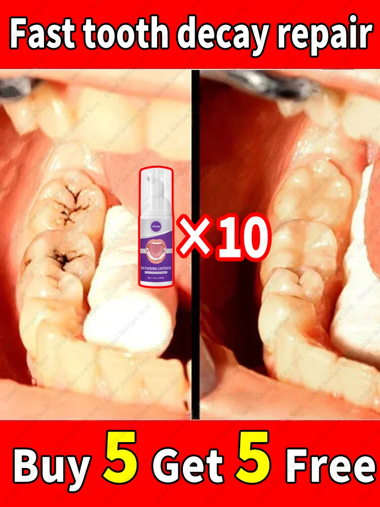 Tooth decay Repair Repairing Cavities Protecting Anti Caries