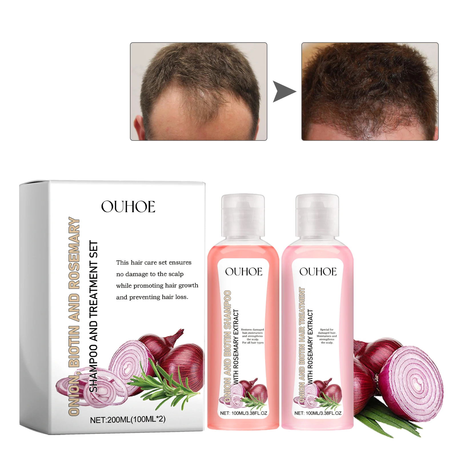 Onion Biotin Rosemary Shampoo Set Nourish Scalp Stabilizing Roots Clean Hair Remove Dandruff Control Oil Shampoo Hair Care Set