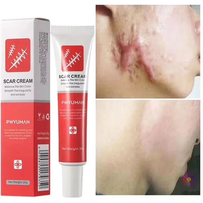 Fast Scar Removal Cream Treatment Stretch Marks Burn Surgical Scar Acne Spots Repair Gel Whitening Moisturizing Smooth Skin Care