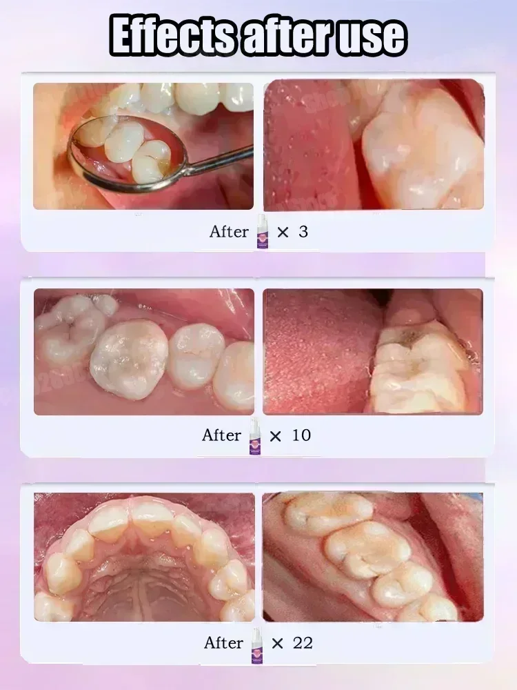 🌳 Más vendido, reparaciones científicas de caries, elimina caries, limpia la placa, blanquea los dientes y refresca el aliento