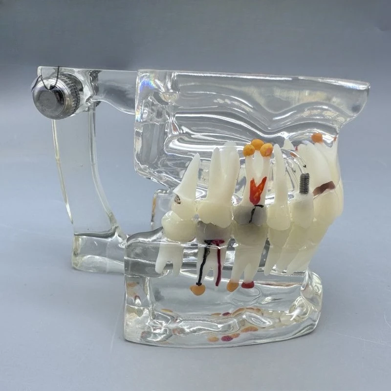 Lab Tooth Model, Transparent Tooth Comprehensive Pathological Model, Teaching Model s