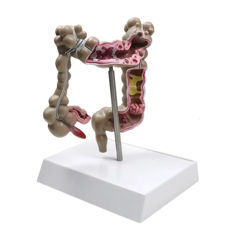 GREATLH Colorectal Lesion รุ่นลําไส้ใหญ่พยาธิวิทยามะเร็ง Colorectal รุ่นการสอนการแพทย์เครื่องมือการเรียนรู้