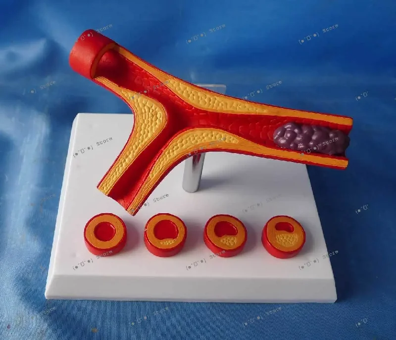 

модель сосудистой активности, патологический тромбоз, кровяные липиды, закупорка сосудов, концентрация жира в крови, патологические кровеносные сосуды