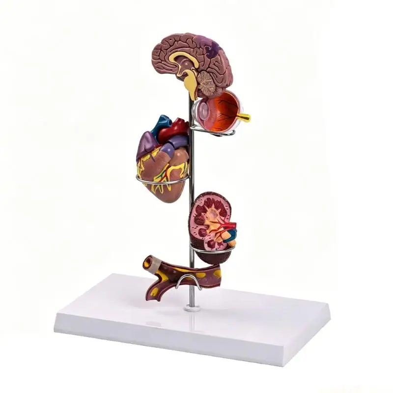 Visual Diabetes Hypertension Educational Model With Pathological Features