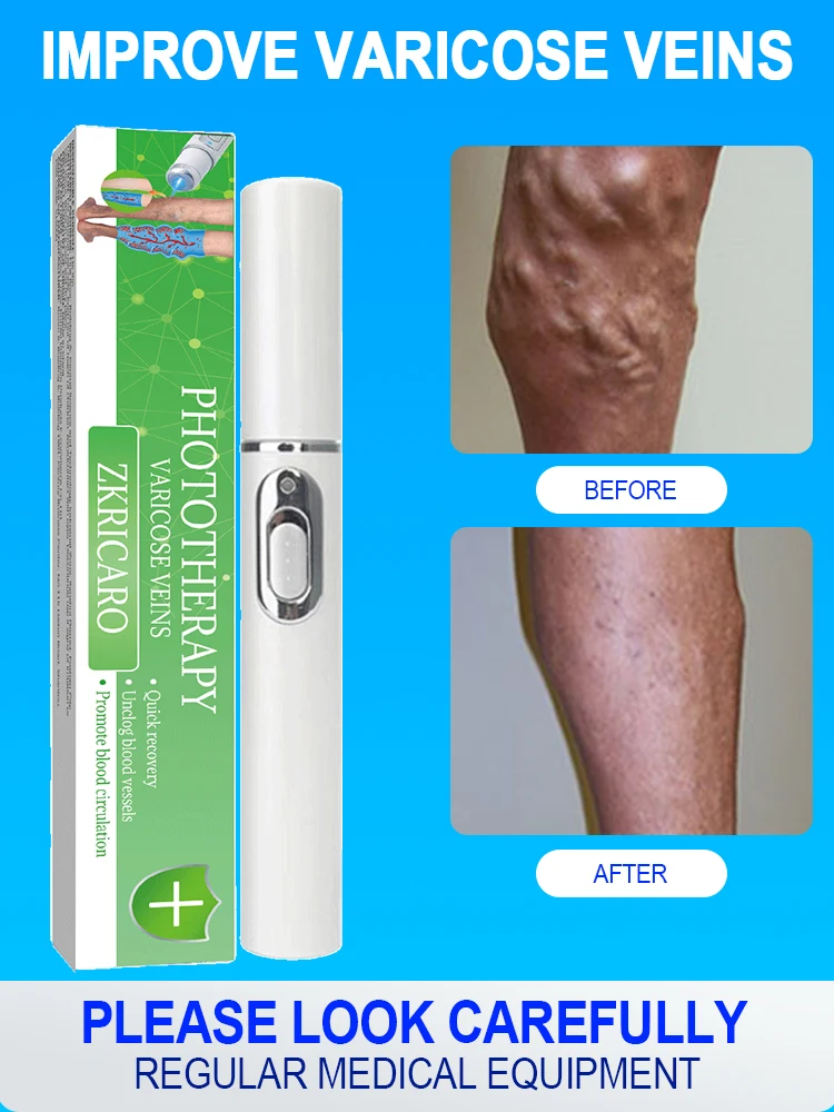 Powerful Laser Therapy for Moderate Varicose Veins, Relieve Pain and Improve Circulation for Both Men and Women