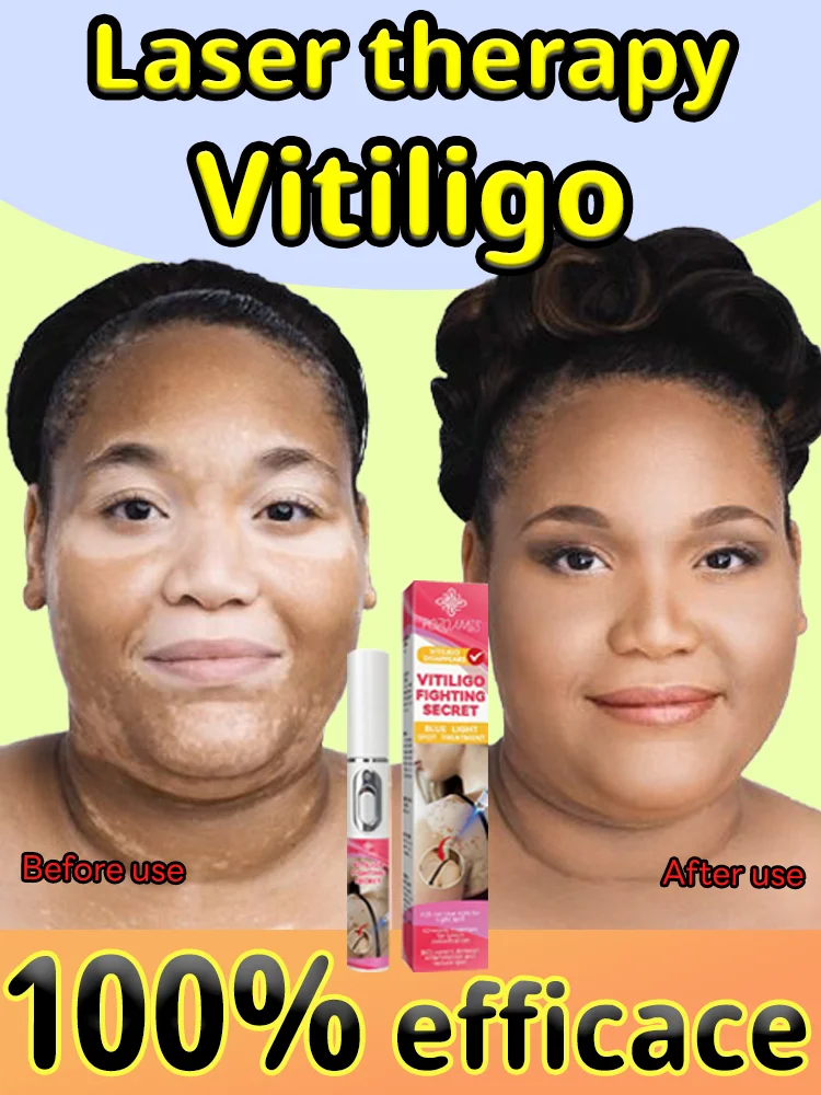 

Laser treatment of vitiligo