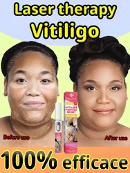 Biostimulation to treat vitiligo