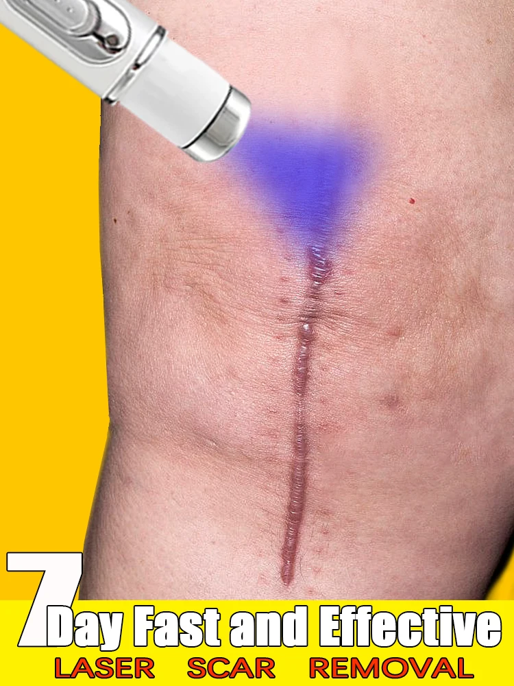 

Laser scar removal effectively repairs old scars, surgical scars, pregnancy scars, acne scars, burn scars