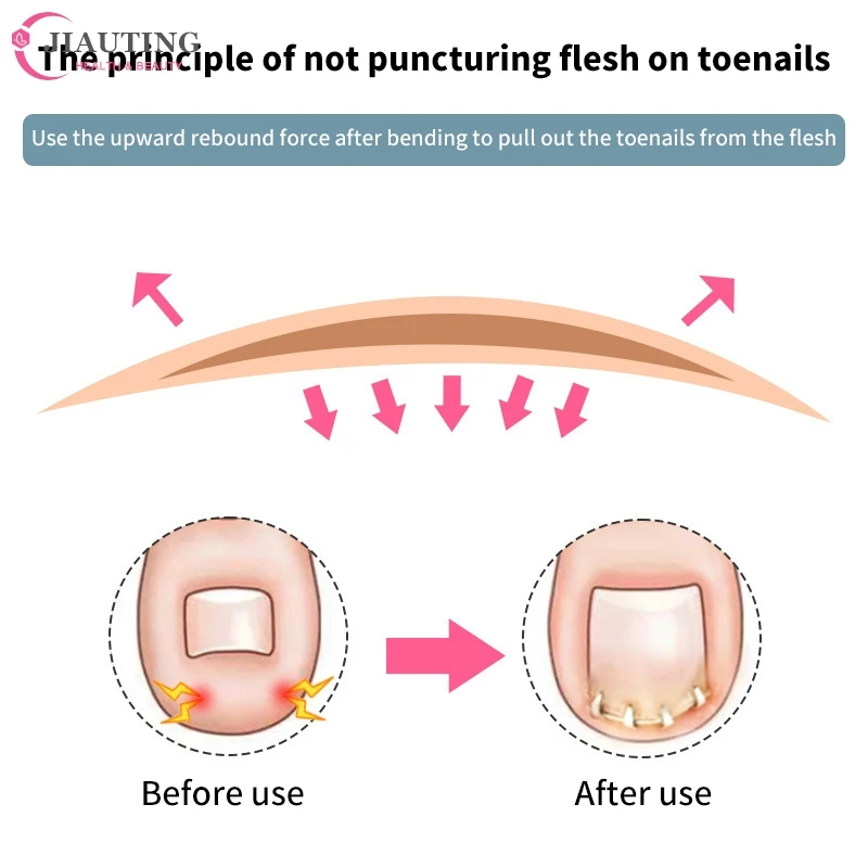 เครื่องมือแก้ไขเล็บเท้าเหล็กคุดที่มองไม่เห็นคลิปหนีบยืดได้1ชิ้น