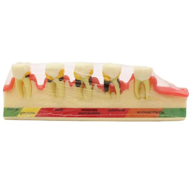 Teeth Periodontal Disease Model Dental Caries breakdown display Periodontitis show Teaching Tooth Model Dentist Communication