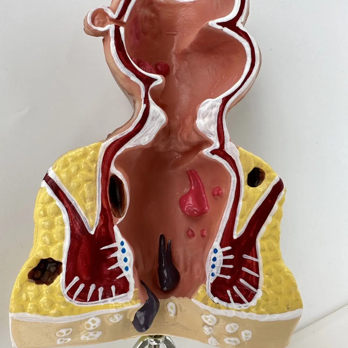 Colorectal Hemorrhoid Disease Model Internal and External Rectal Hemorrhoids Anorectal Department Model Rectal Pathology