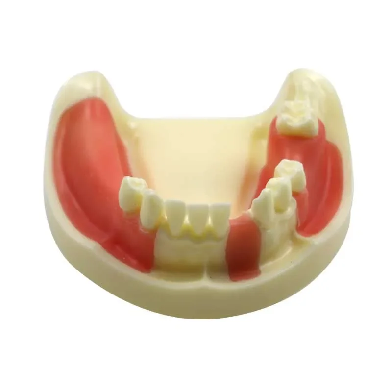 

Dental Lower Jaw Implant Practice Model Dentist Educational Student Teeth Practice Model