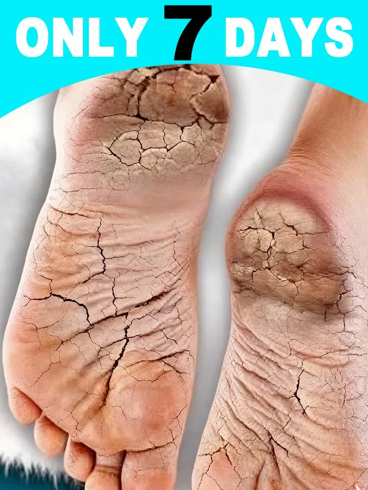 

Hᴇᴀʟɪɴɢ Fᴏᴏᴛ Uʟᴄᴇʀs, Tɪɴᴇᴀ Pᴇᴅɪs, Aɴᴅ Fᴜɴɢᴀʟ Iɴғᴇᴄᴛɪᴏɴs Oғ Tʜᴇ Fᴇᴇᴛ Hot selling