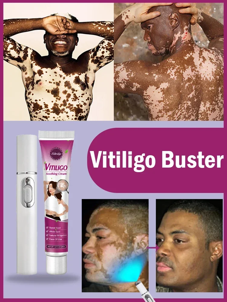 Vitiligo- White Spots Blue Light Lase Technology