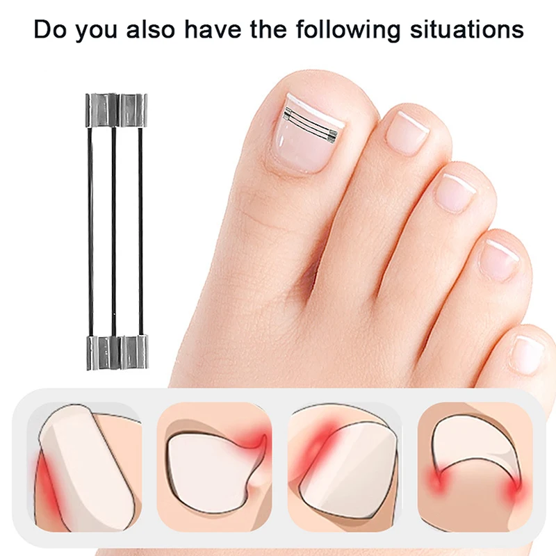 Corrector de uñas encarnadas, herramientas de sujeción, recuperación de pedicura, tratamiento de uñas encarnadas profesional, alisado de uñas encarnadas