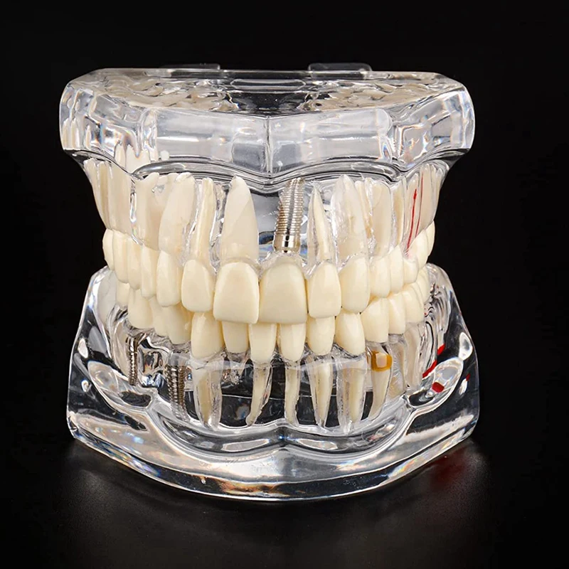 Transparent Disease Teeth Model with Dental Implant Bridge, Dental Model for Patient and Dental Student Education-ABLL