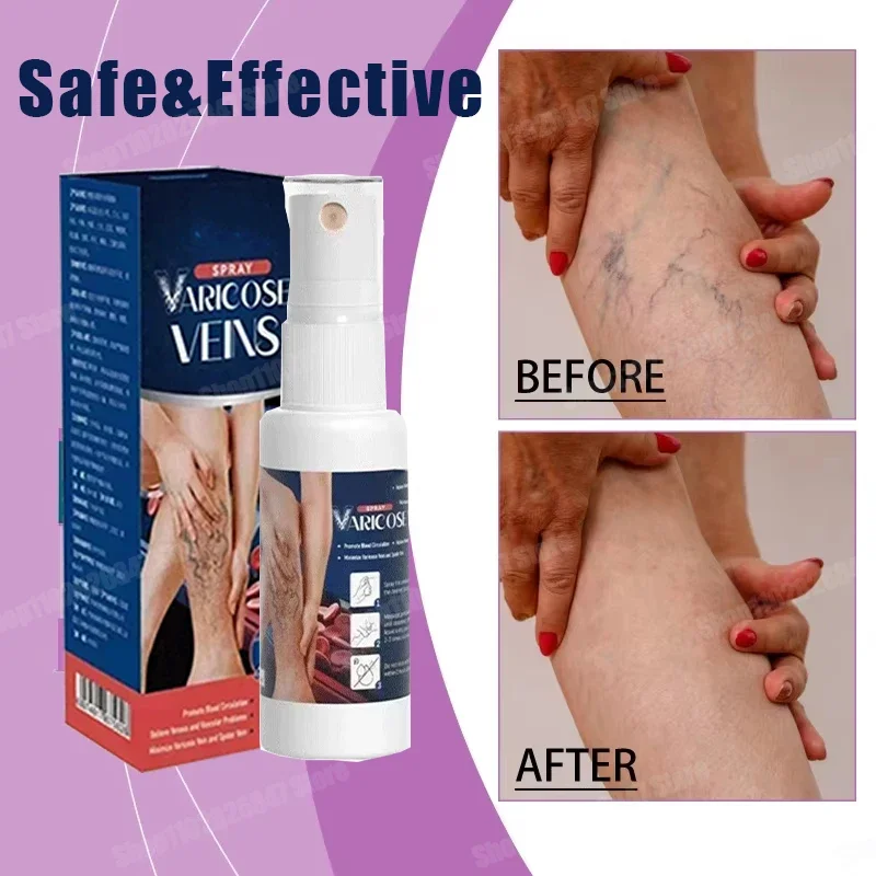 

Varicose Vein Spray Natural Herb Veins Soothing Essential Oil Spray Vasculitis Phlebitis Spider Vein Earthworm Leg Cure