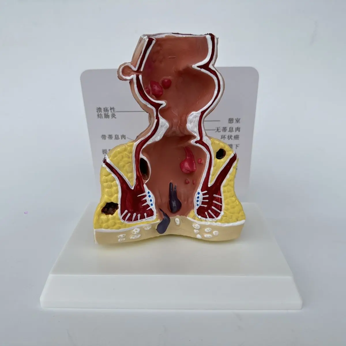 Colorectal Hemorrhoid Disease Model Internal and External Rectal Hemorrhoids Anorectal Department Model Rectal Pathology