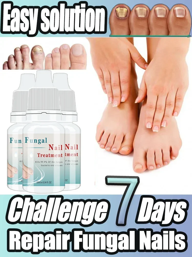 

Nail Fungus Treatment oil Foot Repair Liquid Toe Nails Fungal Removal Gel Anti Infection Paronychia Onychomycosis Serum 10ml