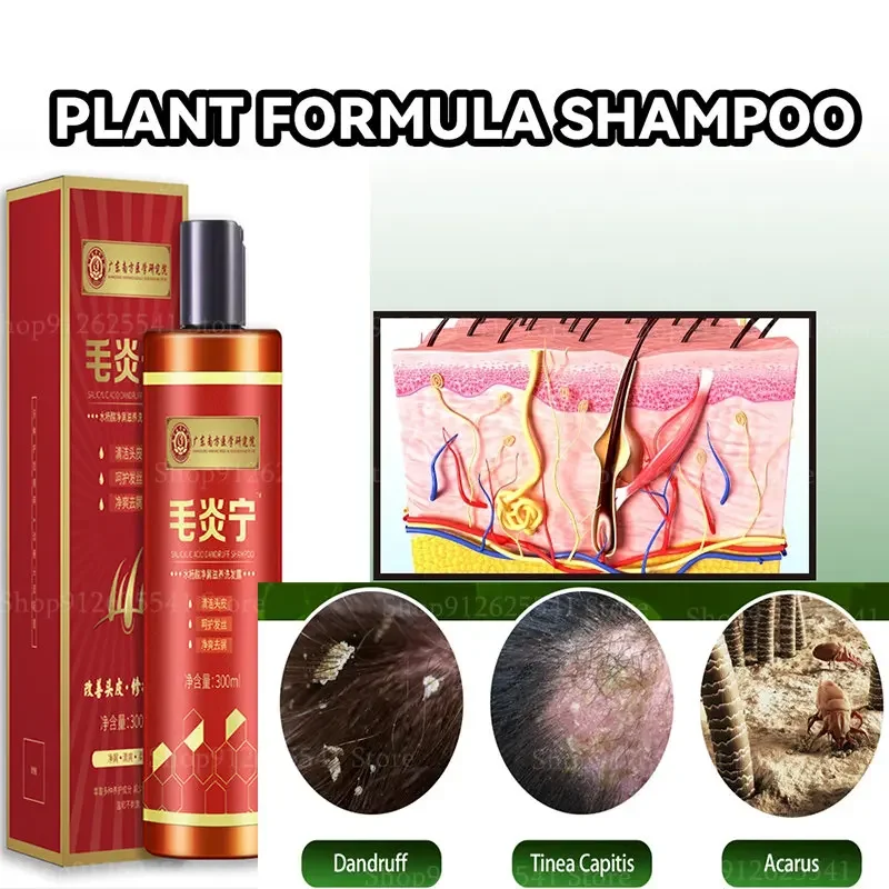 300ML Remove Dandruff Control Itching Antipruritic Shampoo Chinese Herbal Anti-Dandruff Anti-Itch Shampoo Oil-control Refreshing