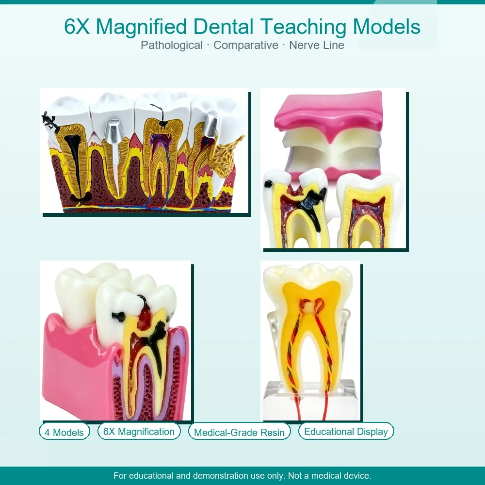 Disease Teeth Model 6 Times Dental Caries Model for Dentals Demonstration Model Dentist Teaching Dental Lab Oral Research