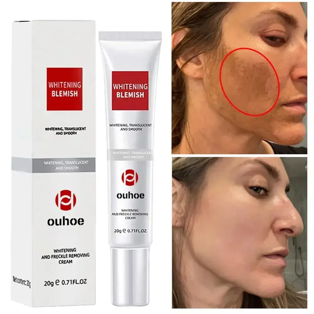 Efficace crema sbiancante lentiggine rimuovi macchie scure crema viso rimozione melanina Melasma schiarire illuminare la cura della pelle corea