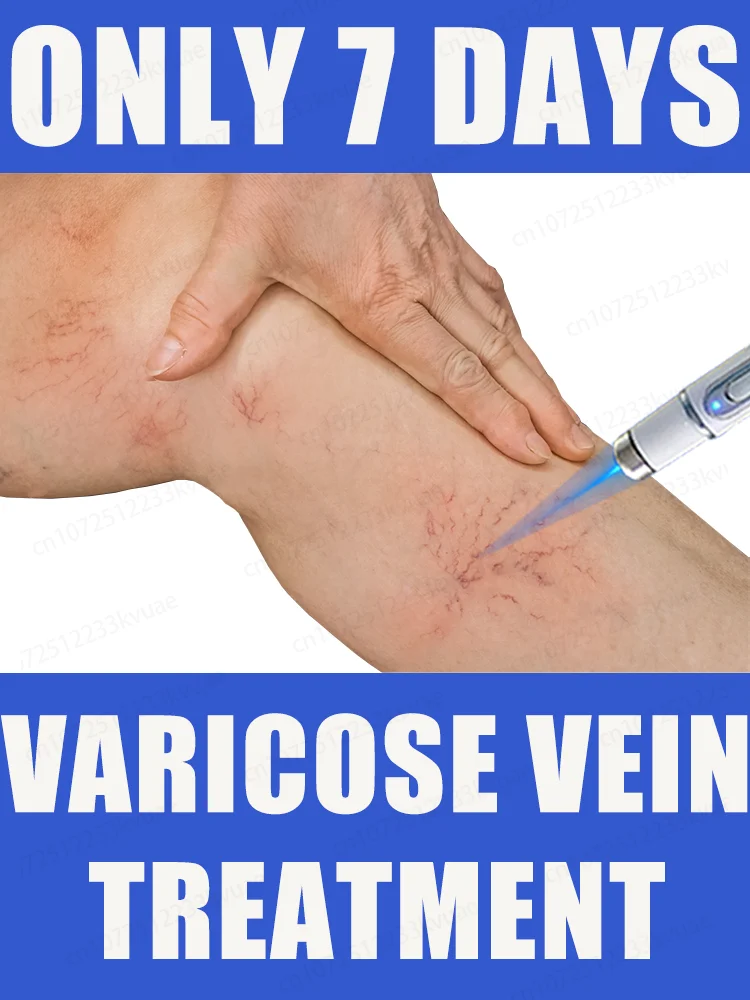 

Laser treatment for varicose veins,ᴍᴇᴅɪᴄᴀʟ grade equipment, painless treatment for spider veins and blood in the legs
