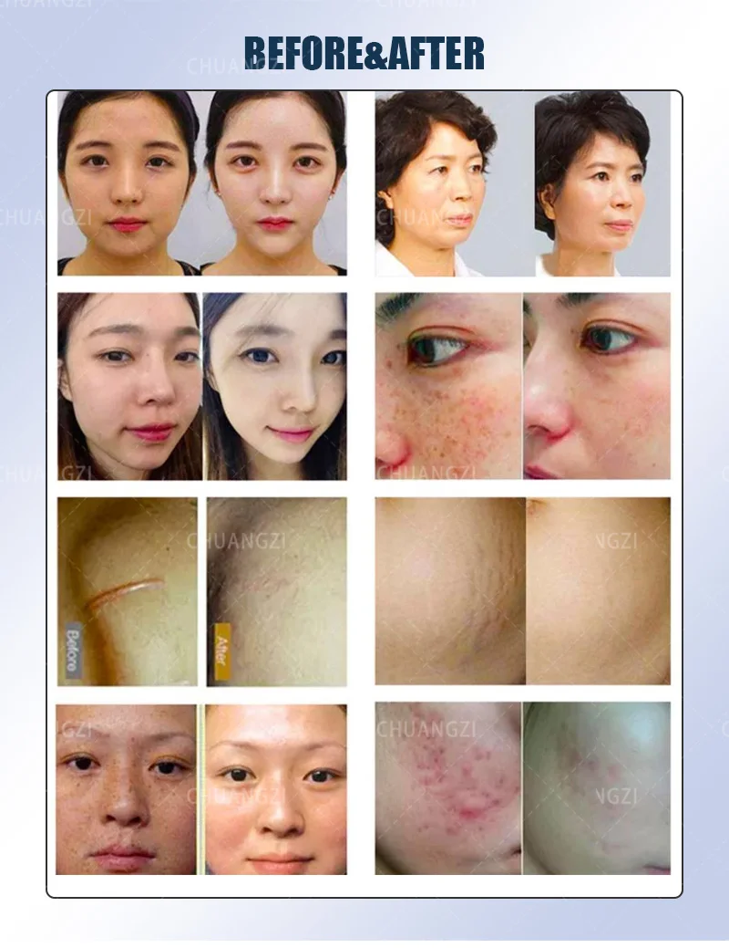 2 In 1 Gold RF Microneedle Machine, Fractional Radiofrequency Microneedling Device for Acne Scar Removal, Stretch Mark Reduction