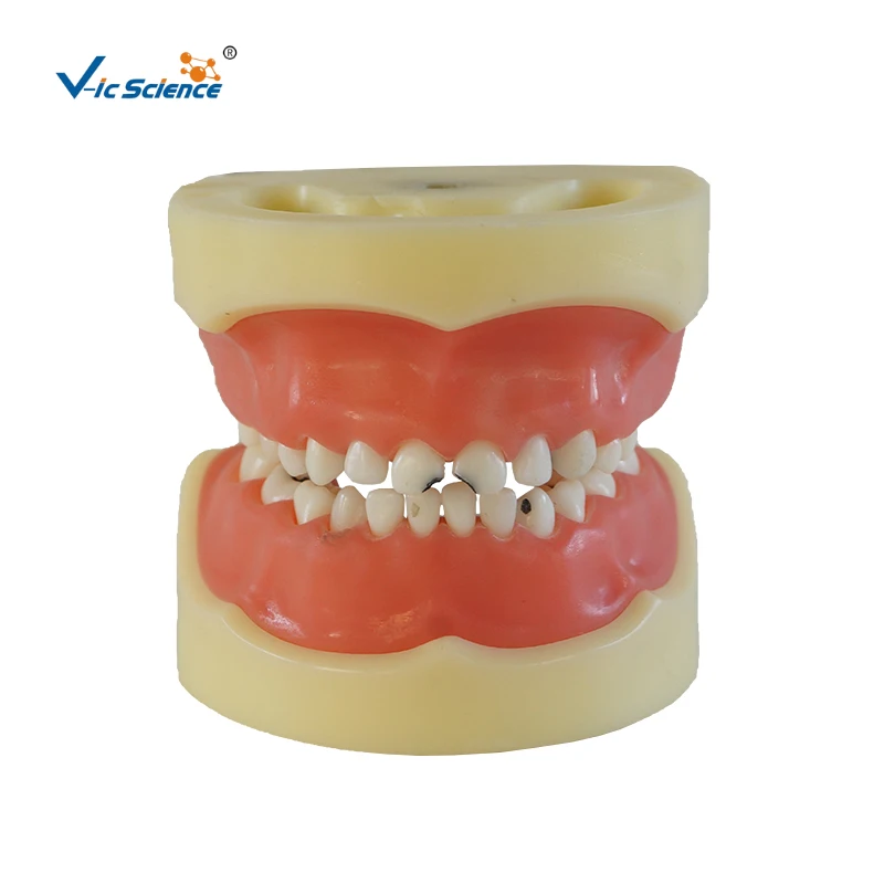 

Children Teeth Caries Model