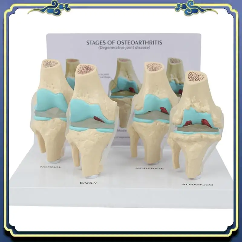 Portable Knee Kit Osteoarthritis Anatomy Model With Educational Key Card 4 Stage Knee Model Orthopedic Teaching Aids