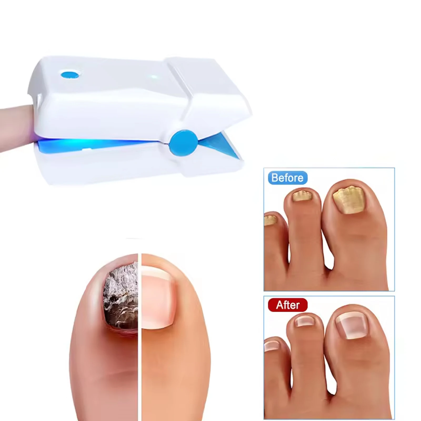 LASEPREHT Nail Fungus Laser Treatment 905nm toenail treatment laser nail laser fungus treatment machine