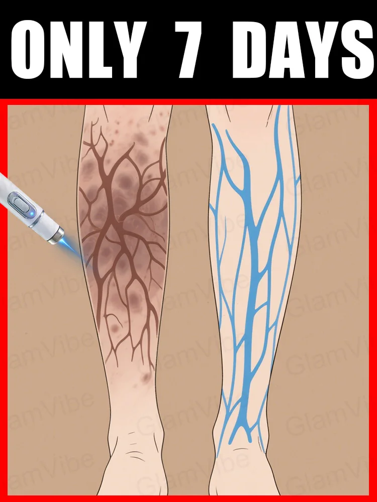 

Leg care tools, blue light pen, varicose veins, 2025 hot sale