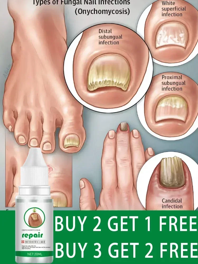 Fungal Nail Treatment Feet Care Essence Nail Foot Whitening Toe Nail Fungus Removal Gel Anti Infection Paronychia Onychomycosis