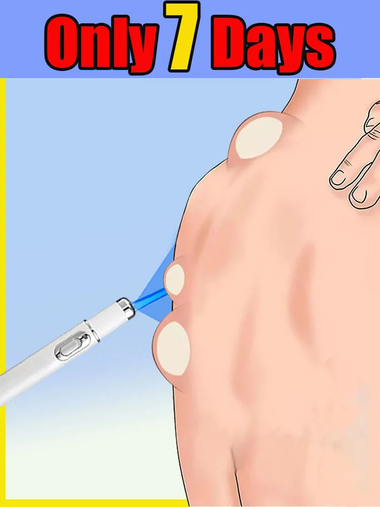 

Newly upgraded blue laser pen for skin care, gently caring for every inch of your skin